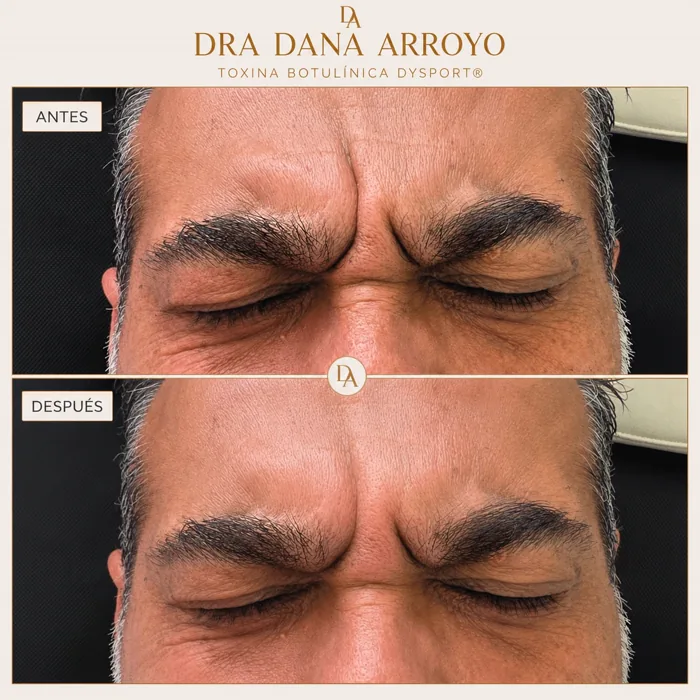 Antes y después del tratamiento en entrecejo