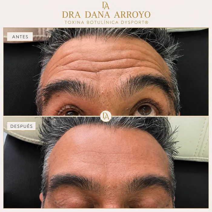 Antes y después del tratamiento en frente